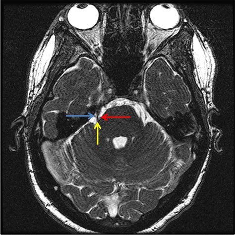 Vascular Loop Blue Arrow Vein Red Arrow Superior Cerebellar Artery