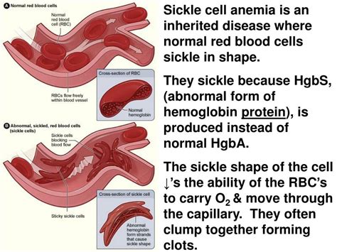 sickle cell anemia   inherited disease  normal red blood