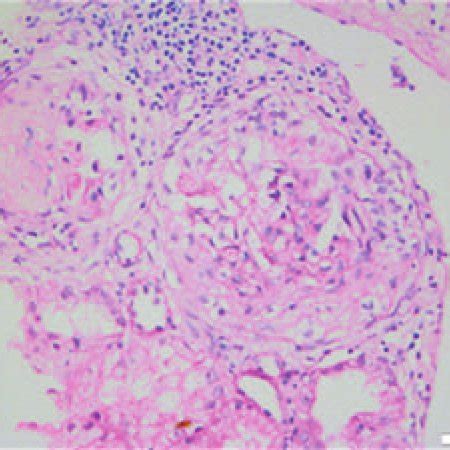 Light Microscopy Findings On Renal Biopsy Fibrocellular Crescent