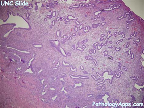 endometrial hyperplasia pathology