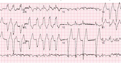 Dr. Smith's ECG Blog: An irregularly irregular wide complex tachycardia