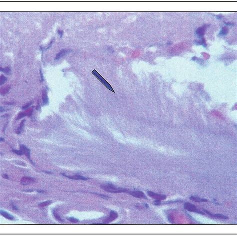 Figure Endomyocardial Biopsy Specimen On Electron Microscopy