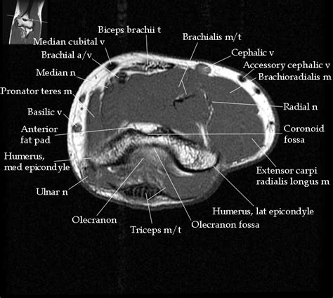 Mri Elbow