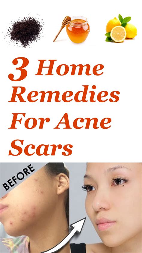 how to remove acne scars naturally in a week 7