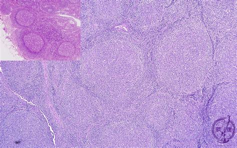 2.Lymph node (5) Follicular lymphoma|Pathology Core Pictures