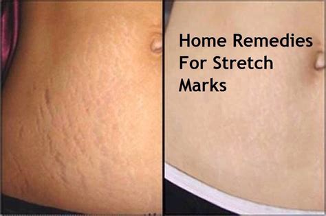 Home Remedies For Stretch Marks 👌 Trusper