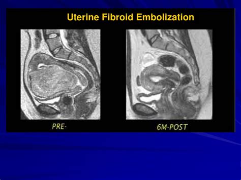 PPT - UTERINE FIBROIDS PowerPoint Presentation, free download - ID:9233526