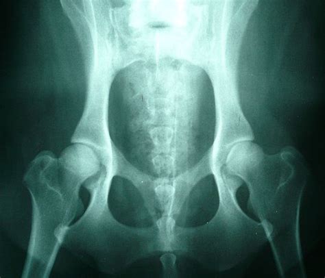 Maremma Sheepdog Normal Hips In Dogs Without Canine Hip Dypslasia