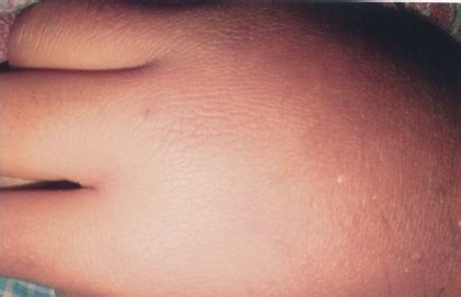 local swelling  ecchymosis   site  viper bite