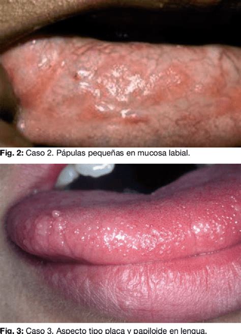 Figure 9 From Hiperplasia Epitelial Focal Enfermedad De Heck Nuestra