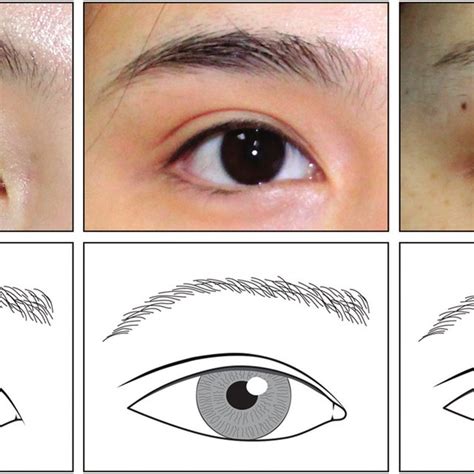 comprehensive approach  upper   eyelid rejuvenation oom