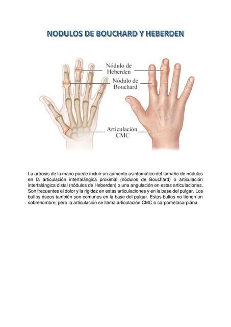 Nodulos De Heberden E Bouchard - Flashcards de NODULOS DE BOUCHARD Y HEBERDEN | Por AFStudentHelp | uDocz