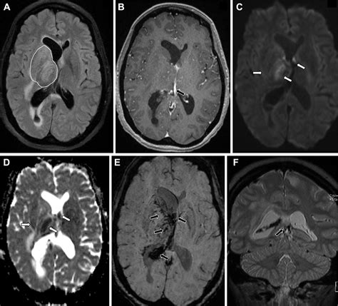 Case 313 Cerebral Venous Infarct Due To Internal Cerebral Vein