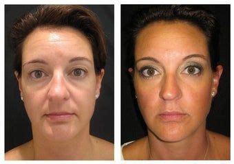 Ultherapy Before After Pictures Realself Skin Care Procedures