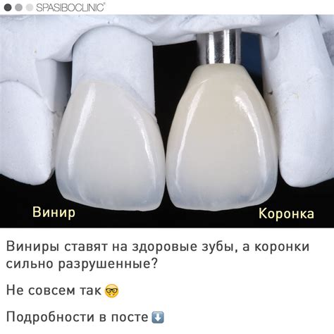 ВИНИРЫ ИЛИ КОРОНКИ? | Спасибо.Клиник | Дзен