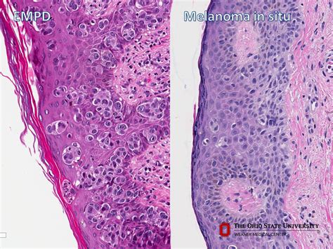 Vulvar Melanoma Pathology