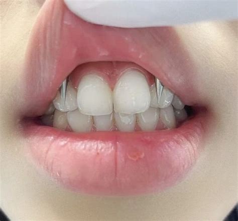 прокол смайл | Piercing