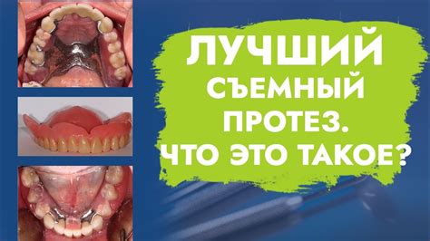 Лучший съемный протез. Что это такое? - YouTube