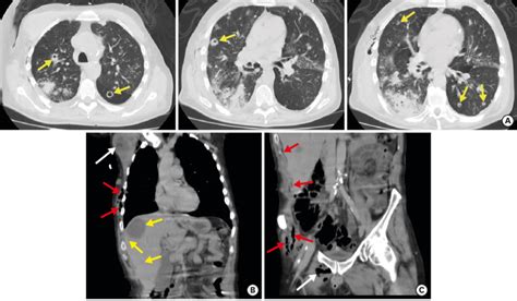 A Three Panel Axial Chest CT Demonstrating Multiple Lung Nodules With