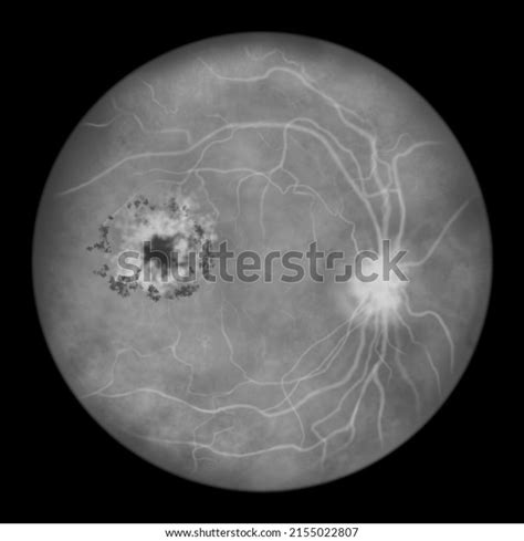 cystoid royalty  images stock  pictures shutterstock