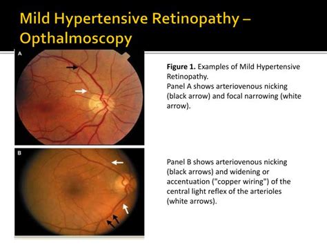 Grade Hypertensive Retinopathy