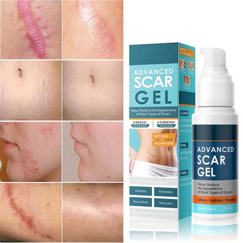 Amazon.com : Scar Cream Advance Scar Gel for Surgical Scars, Burns ...