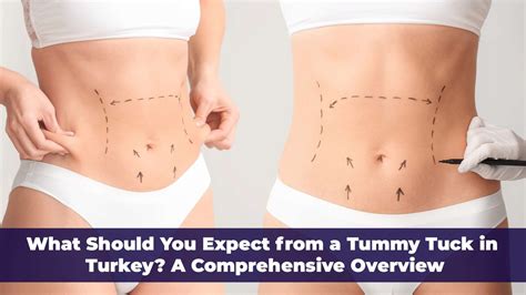 What Should You Expect From A Tummy Tuck In Turkey