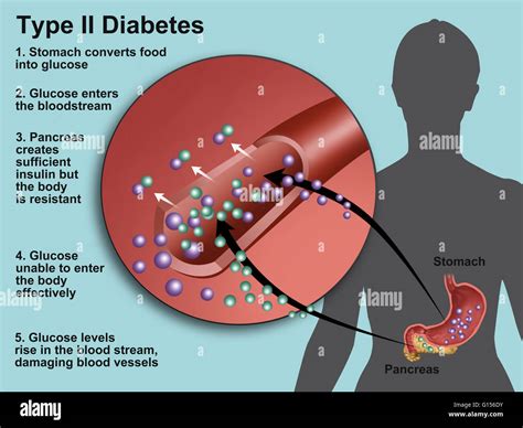 Type 2 Diabetes Insulin - DiabetesWalls