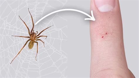 15 Types Of Spider Bites: Identification Chart with Picture