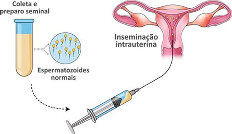 Como Se Escreve Inseminação - Inseminação Artificial – Clínica Conceptus