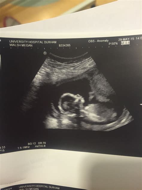 Gender Predictor How To Tell Your Baby S Sex At The Week Scan Artofit