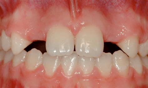 What Can We Do About Missing Lateral Incisors Kevin Obriens