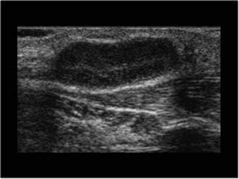 Lymphoma Lymph Nodes Ultrasound