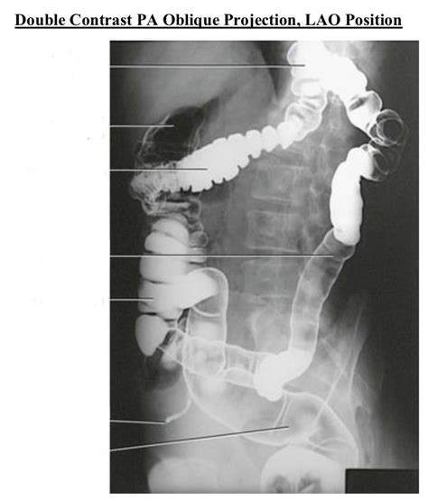 Double Contrast PA Oblique Projection LAO Diagram Quizlet