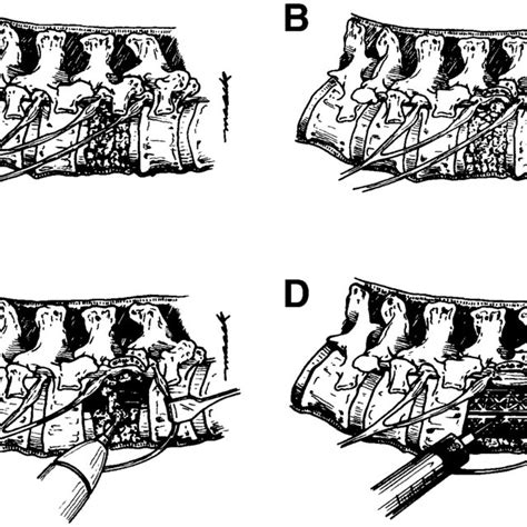 lateral extracavitary approach   spine  lateral view