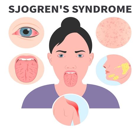 Sjogrens Syndrome