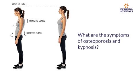 Women Was a Hunchback: How to Avoid Kyphosis of the Spine and Other Osteoporosis Symptoms