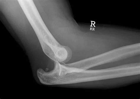 The Elbow Joint Structure Movement Teachmeanatomy