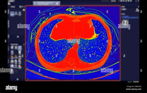 Ct Scan Of Chest Axial View In Color Mode For Diagnostic Pulmonary