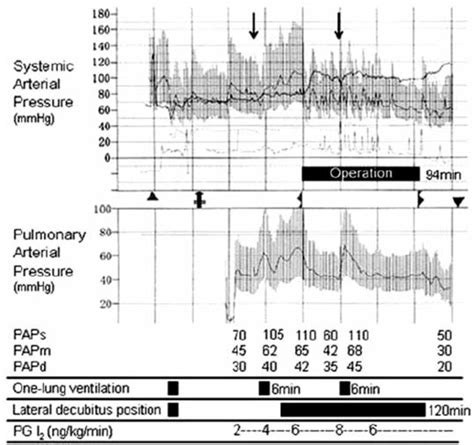 Intraoperative Hemodynamics The Arrows Represent The Onset Of One Lung