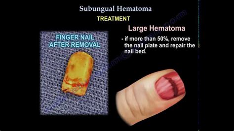 Haematoma Nail Bed How To Heal