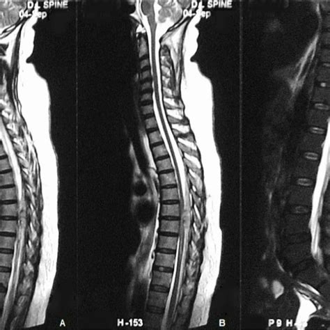 T2 Weighted A And B And Fat Suppressed T2 Weighted C Sagittal