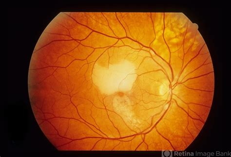 Susac S Syndrome Retina Image Bank