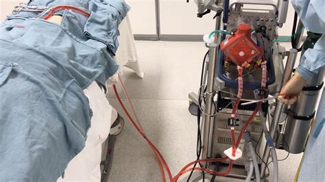 Ecmo