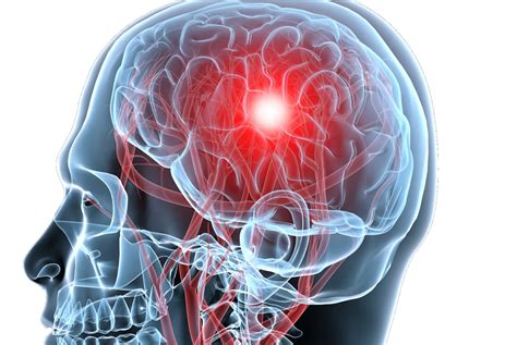 proactive  concussions  student athletes michigan