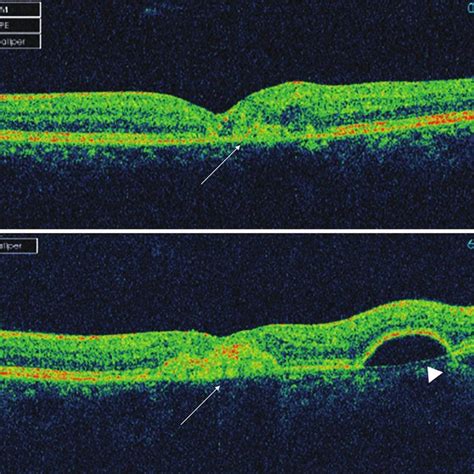 Spectral Domain Optical Coherence Tomography Of The Right Eye Showing Download Scientific