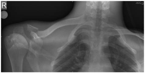 Sternoclavicular Dislocation Wikem