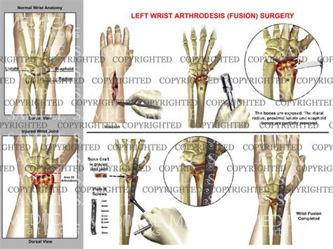 Left wrist arthrodesis surgery — Medical Art Works