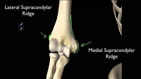 Distal Humerus Fracture - Carolina Regional Orthopedics