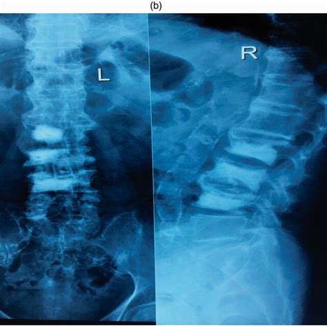 Anteriorposterior A And Lateral B Views Of Lumbar Spine X Ray